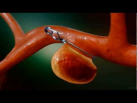 Cerebral Aneurysm Clips Market Size, Share, Growth, Opportunities and Global Forecast to 2028