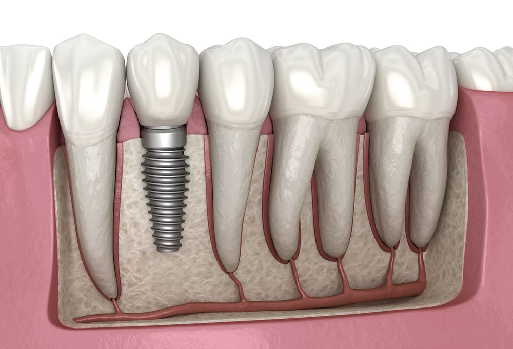 What are the Different Types of Dental Implants?