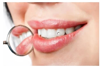 A Complete Guide About The Best Professional Teeth Whitening Process