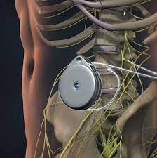 Intrathecal Pumps Market Size, Share, Regional Overview and Global Forecast to 2028