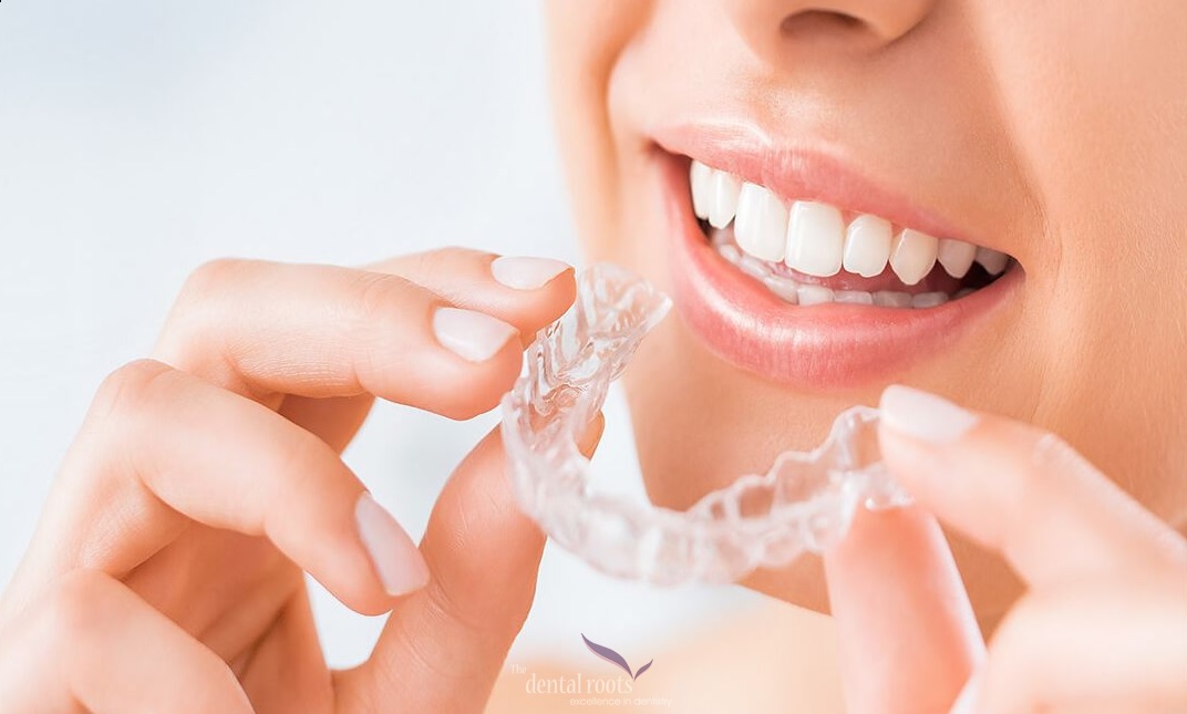 Embark a Flawless Smile Journey with Invisalign Aligners in India