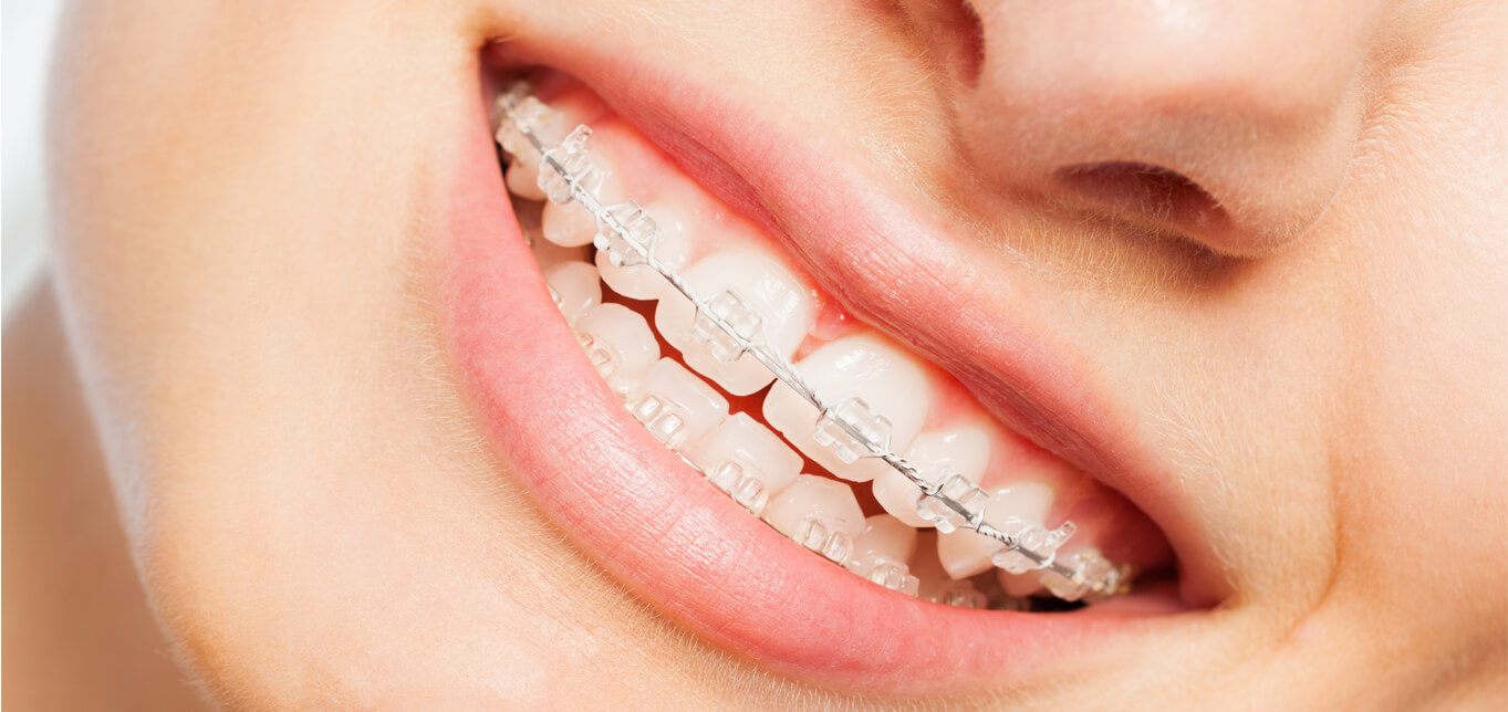 Ceramic Braces: An Alternative to Clear Aligners