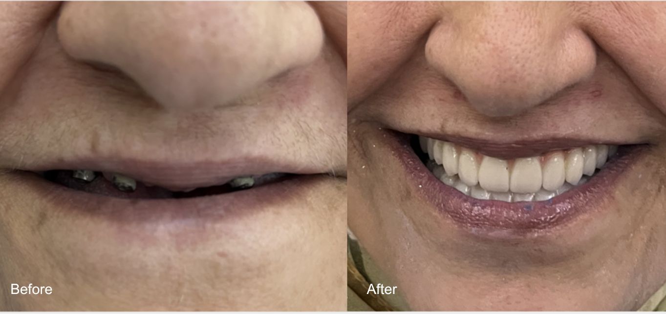 Get Your Perfect Smile Back with All-on-4 Dental Implants