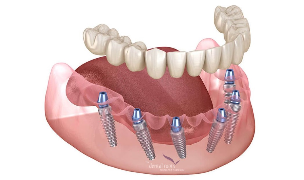 All-on-6 Dental Implants in Gurgaon, South Delhi, India