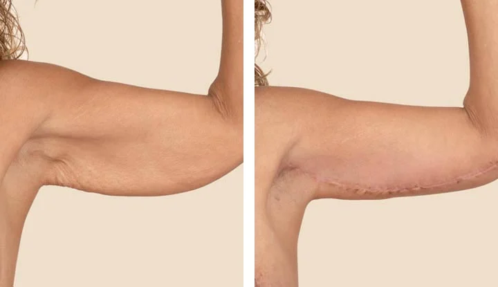 Unveiling the Secrets to Flawless Arm Lift Surgery Maintenance