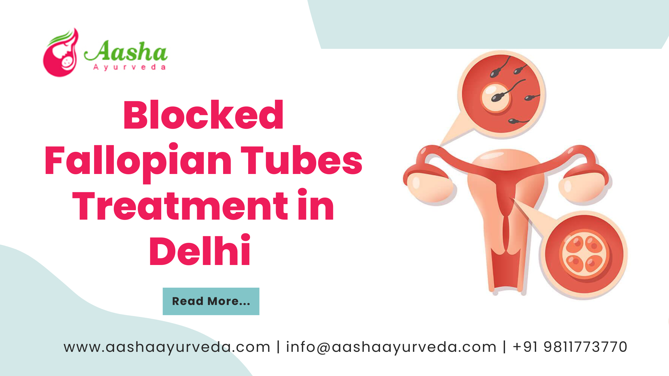 Blocked Fallopian Tubes Treatment in Delhi
