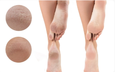 Reasons To Pick Up Soft Foot Cream Right Now 