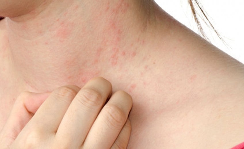 What Diet To Take In Urticaria?