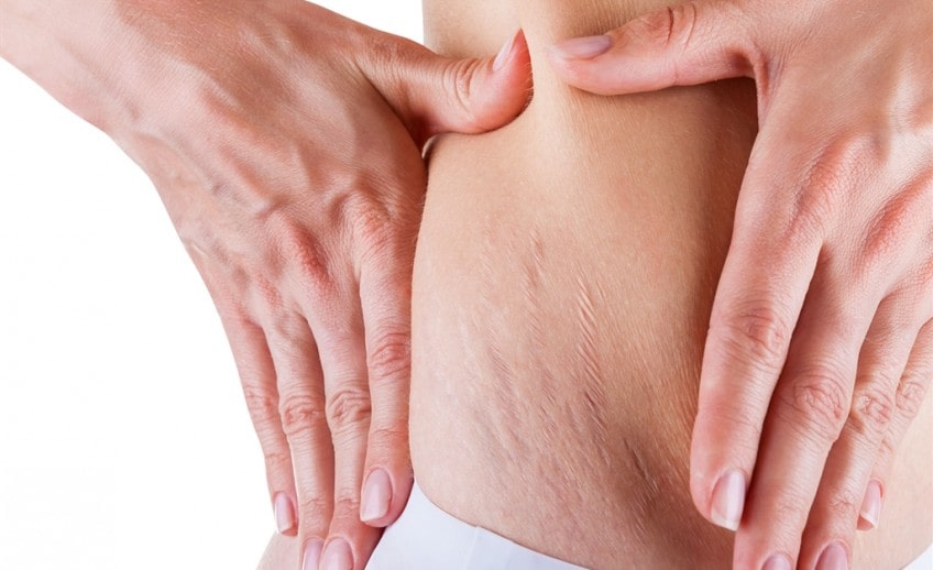 Can Laser Treatments Really Help Get Rid of Stretch Marks? 