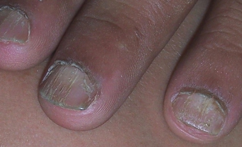 Experienced Finger Nail And Toe Nail Avulsion- What To Do?