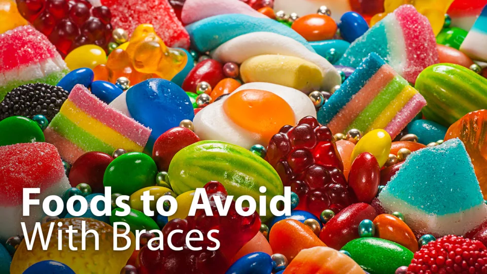 What Foods to Avoid When Wearing Braces