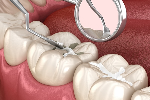 Advantages of Dental Sealants