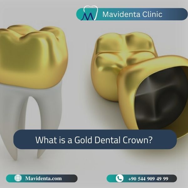 Zirconia vs Gold Crown: Which is the Best for Your Teeth?