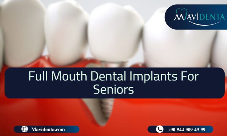 Full Mouth Dental Implants For Seniors