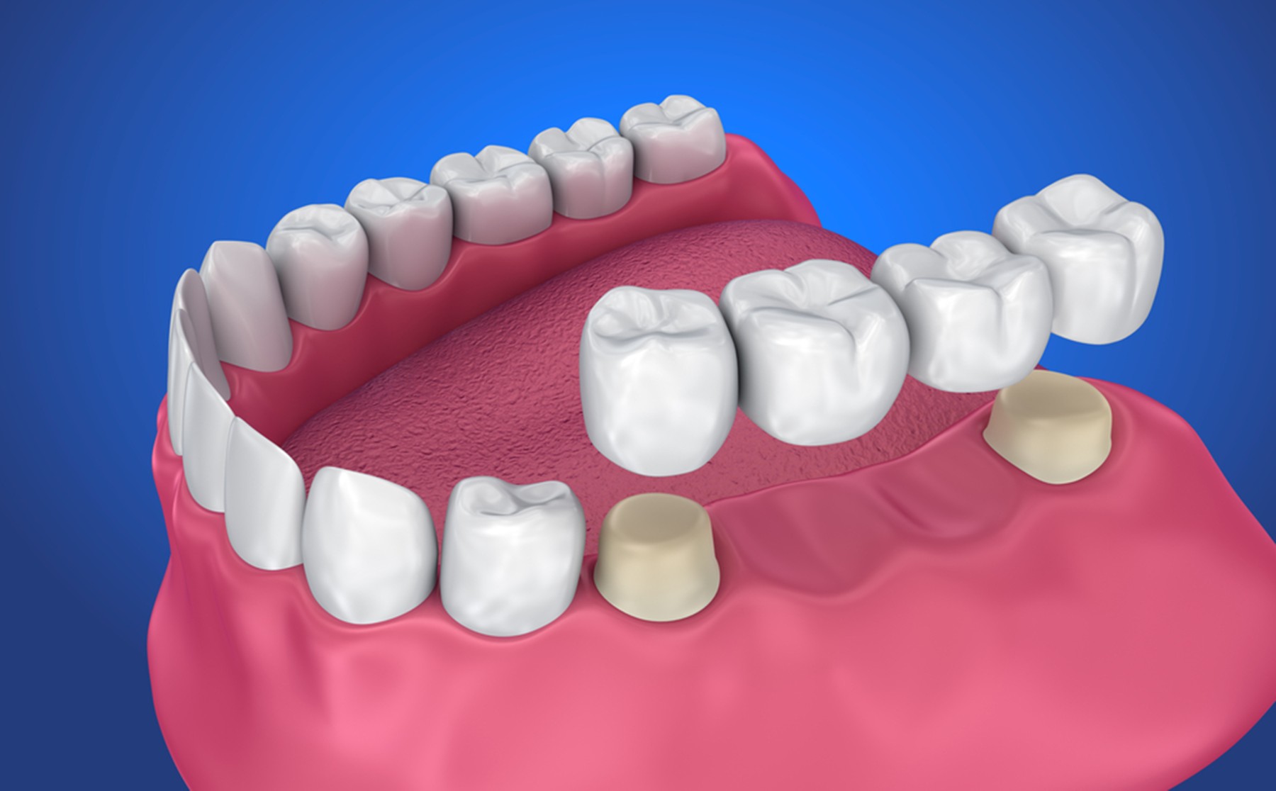How to Choose the Right Dental Bridge for You?