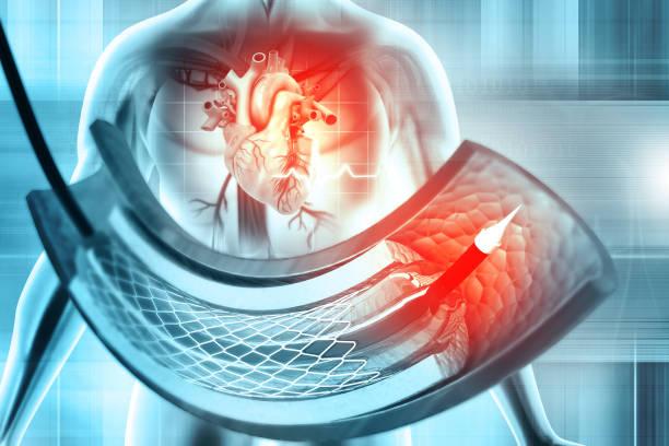 Rising Demand for Minimally Invasive Surgeries Drives Catheters Market Growth