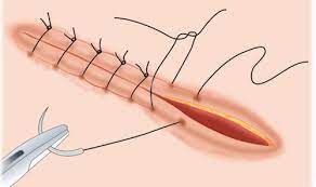 Sutures Market Huge Growth in Future Scope 2023-2030