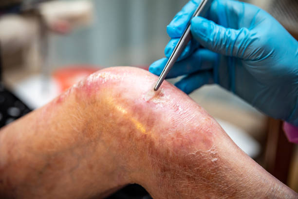 Epidermolysis Bullosa Market to Grow at Highest Pace Owing to Increasing Research and Development Activities 