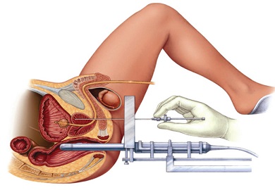 Brachytherapy Market 2025 Key Trends By Top Opportunities, Challenges And Growth Factors