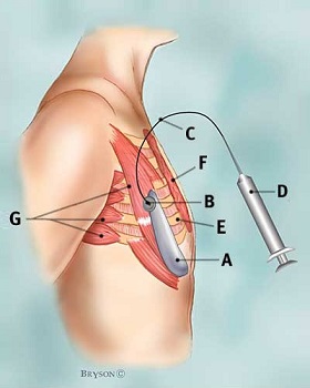 Tissue Expander Market Revenue, Pricing Trends, Growth Opportunity, Regional Outlook And Forecast To 2025