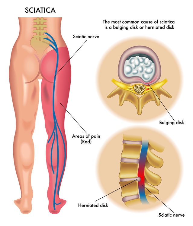 Visit Neuro spine clinic for spinal surgery