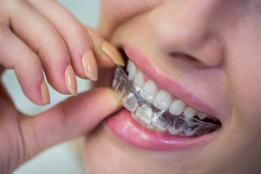 Advantages of Invisalign over traditional braces