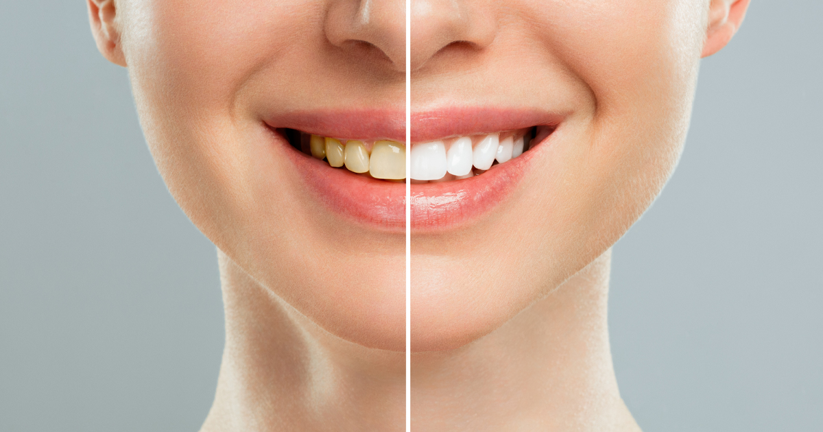 The Ultimate Guide to Achieving a Brighter Smile: Expert Tips for Teeth Whitening