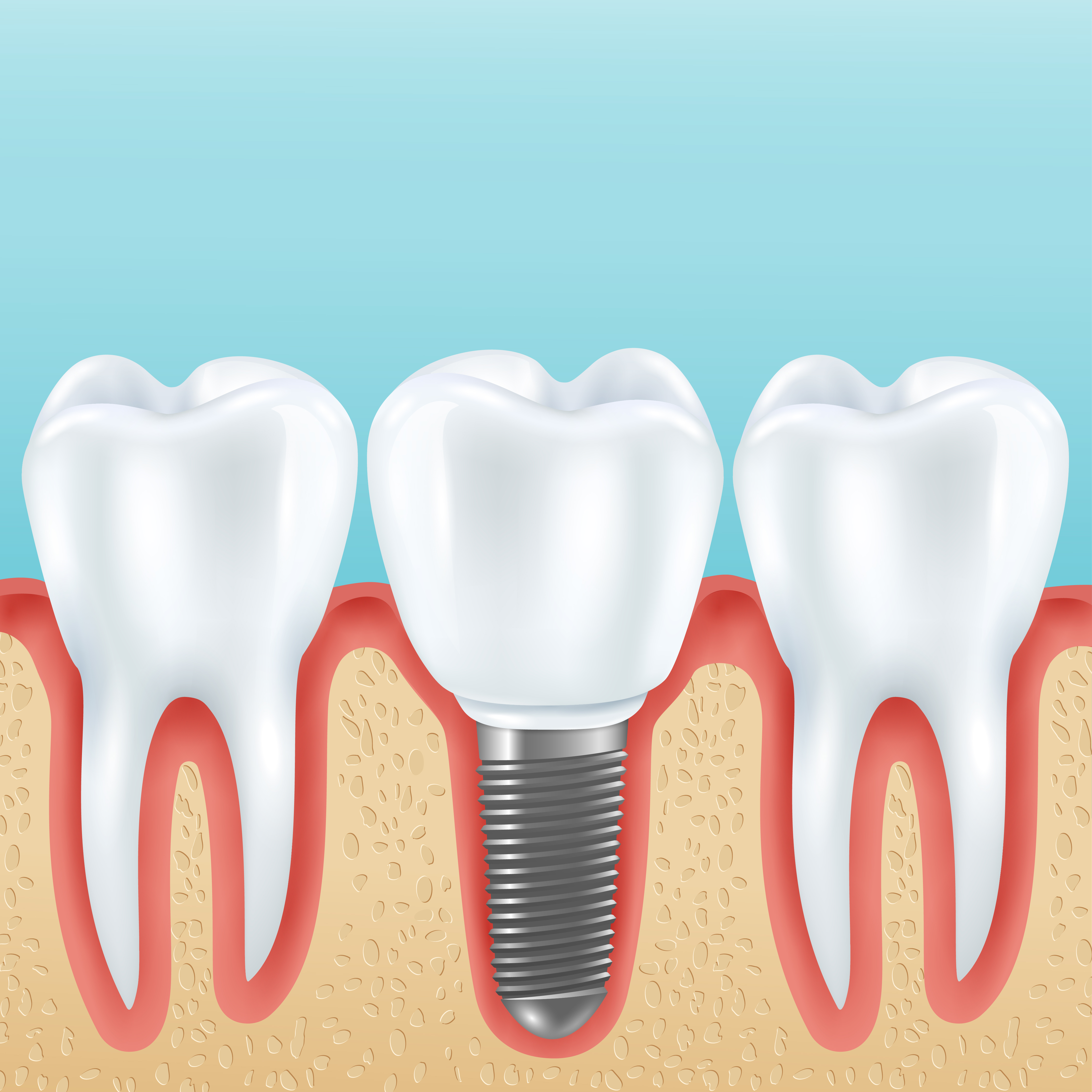 Dental Implant Maintenance: What You Need to Know to Keep Your Smile Healthy