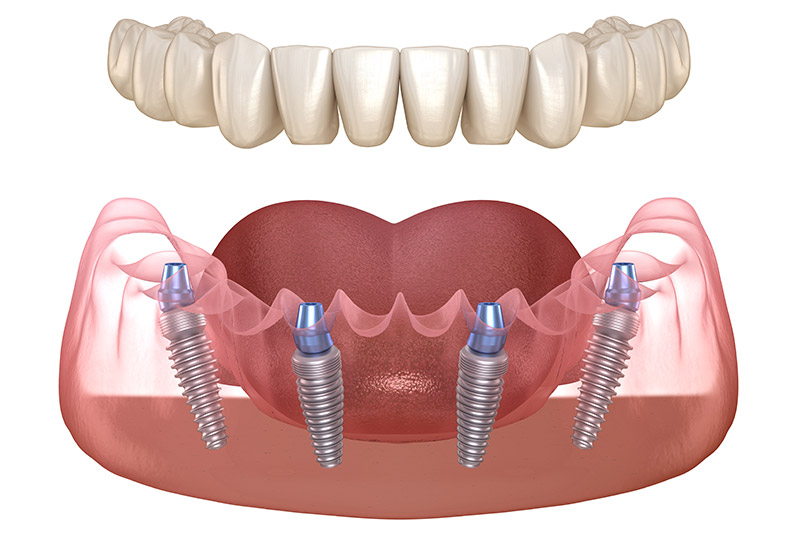 Understanding Dental Implants: Types and Materials Used in India