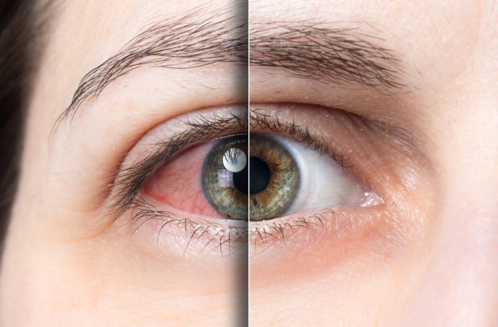 Is Dry Eye Laser Treatment Right for You? Here's What to Consider