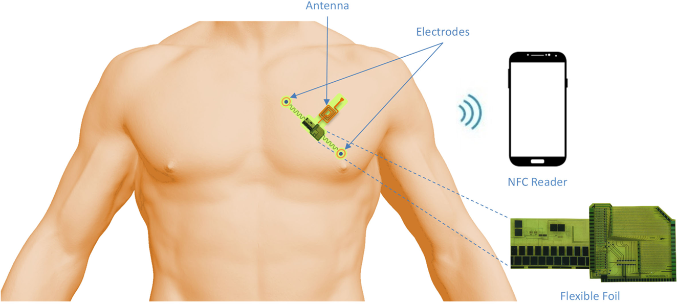 The Global ECG Sensor Patch Market Growth Accelerated By Increased Demand For Remote Patient Monitoring Services