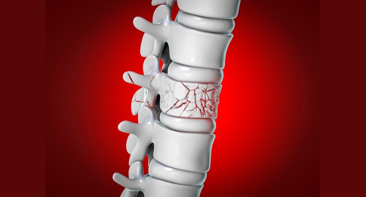 A Comprehensive Study of Vertebral Compression Fracture Devices