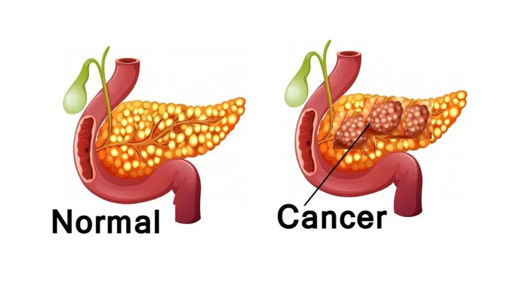 Pancreatic Cancer Therapeutics and Diagnostics: Progress and Challenges Ahead