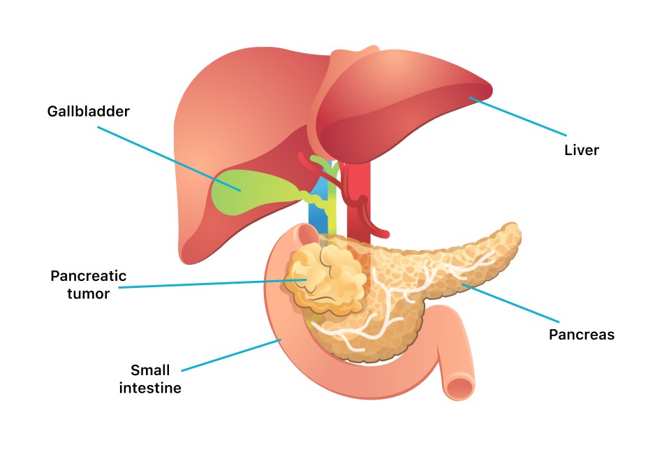 Immunotherapy is fastest growing segment fueling the growth of pancreatic cancer therapeutics and diagnostics market