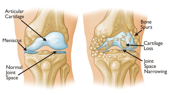 Total Knee Arthroplasty is Estimated to Witness High Growth Owing to Rapidly Aging Population