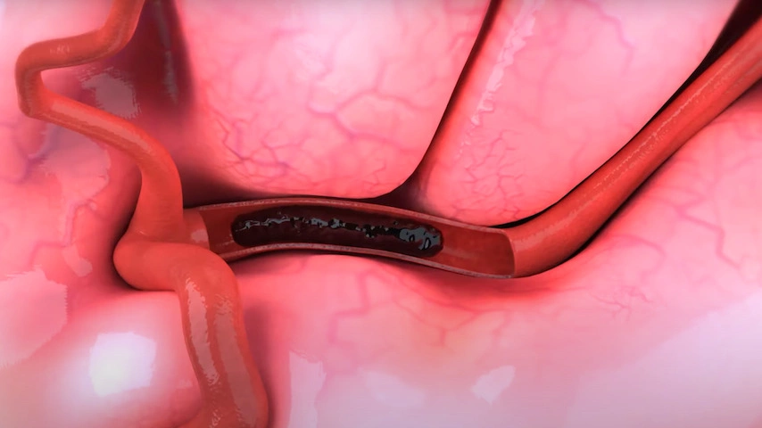 Tissue Plasminogen Activator Therapy is Estimated to Witness High Growth Owing to Opportunity in Neurovascular Conditions Management