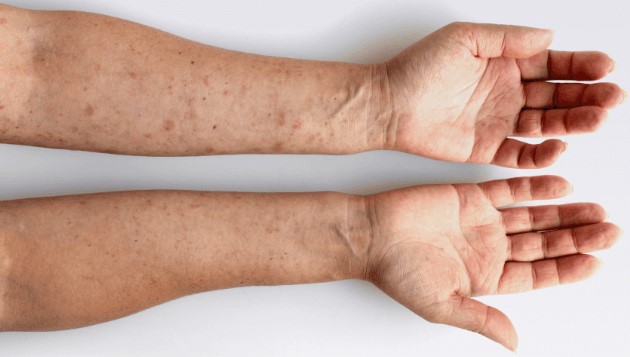 Hereditary Angioedema Treatment Market Competitive Landscape and Regional Forecast 2025