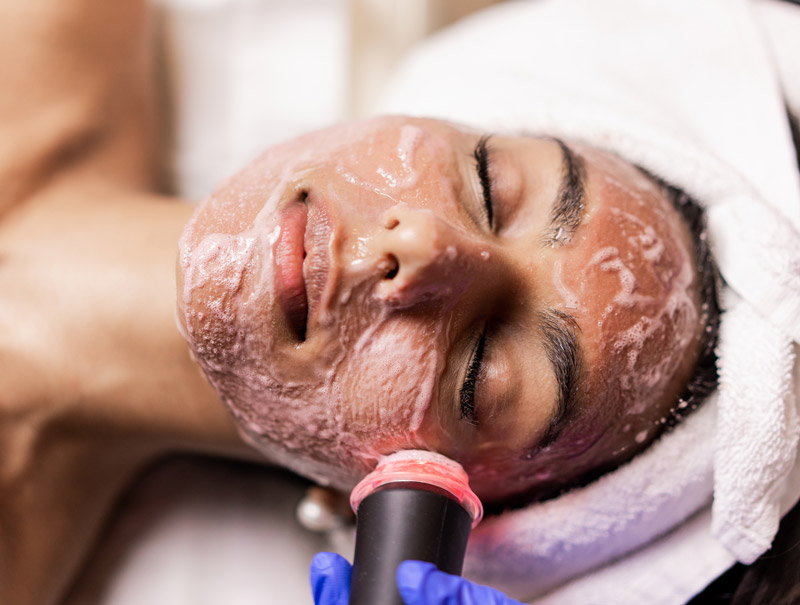 Get Herbal Green Peel Services in London, Ontario