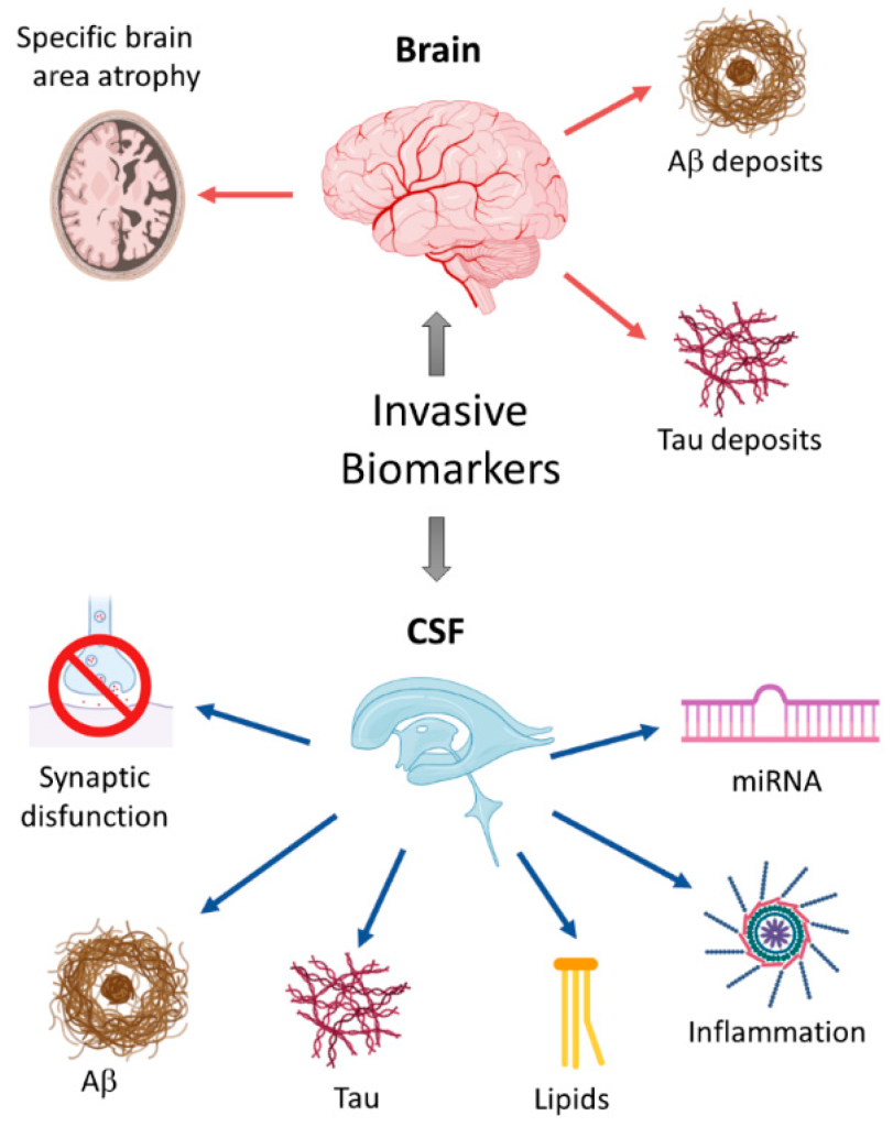 Alzheimer’s Disease Diagnostic Markers