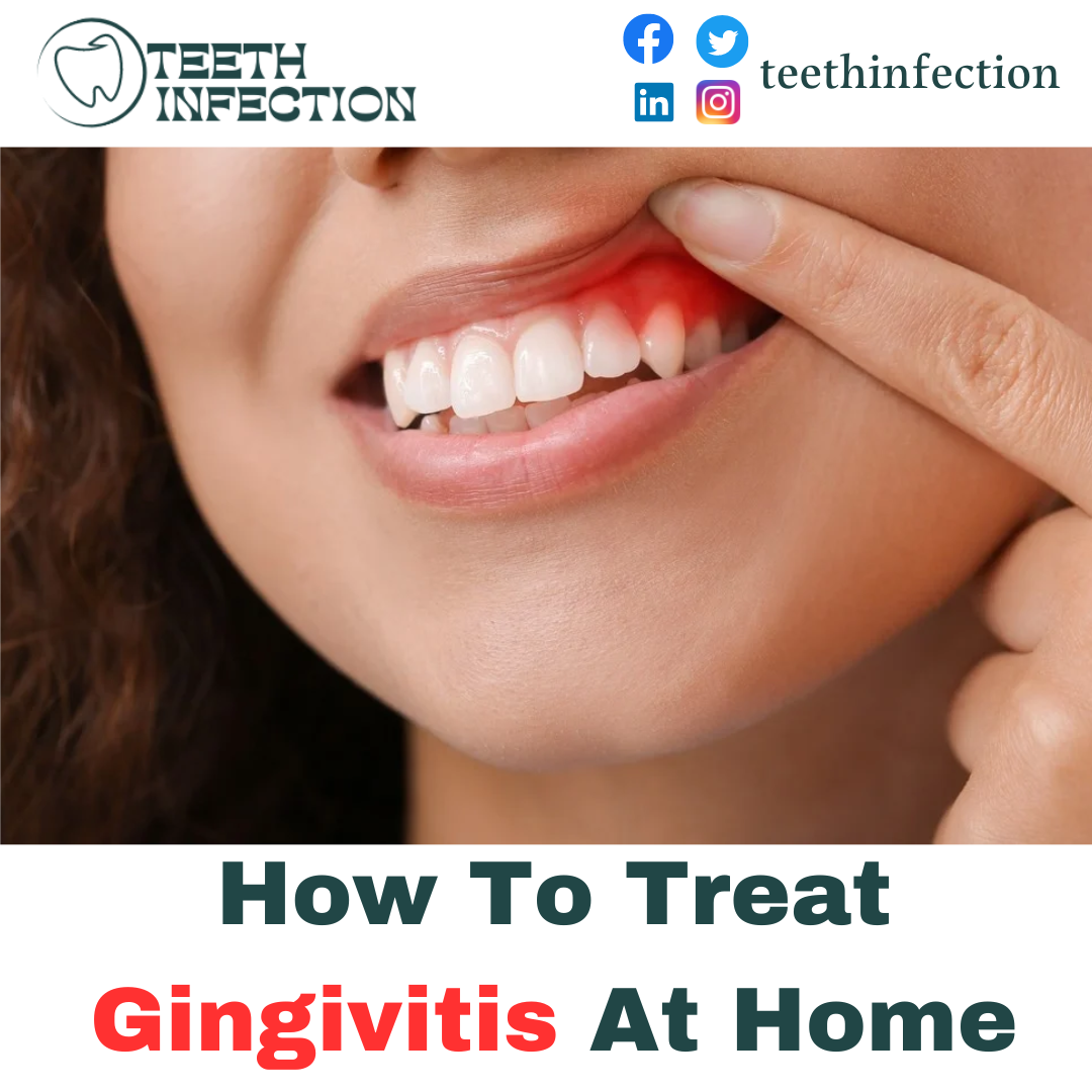 How To Treat Gingivitis At Home 