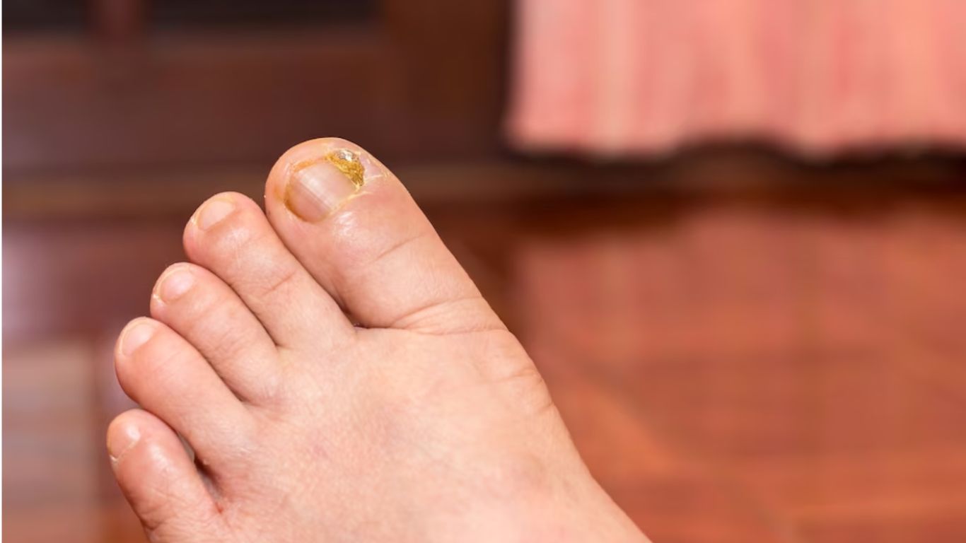 Keratin Granulation: What It Is and How to Prevent It