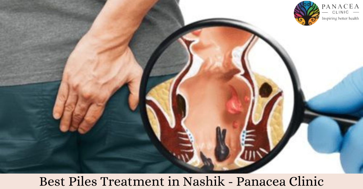 Best Piles Treatment in Nashik – Panacea Clinic