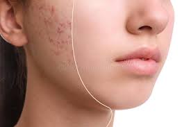 What is Acne: Understanding the Root Causes and Treatment Options
