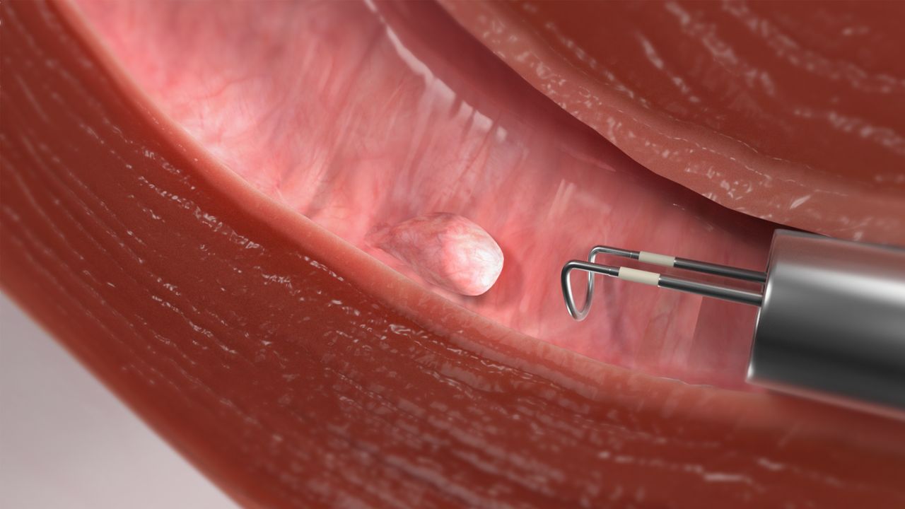 What Are the Common Symptoms of Uterine Polyps, and How Are They Treated?