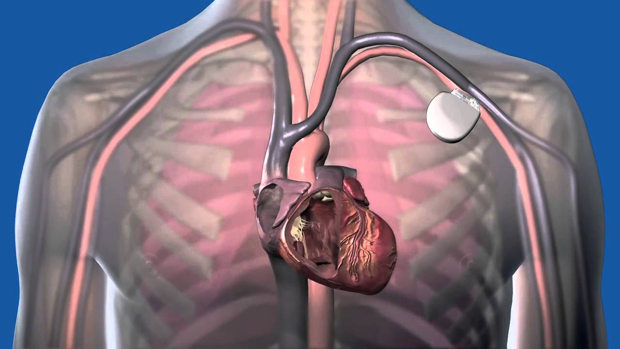 The Evolution of Cardiac Assist Devices Industry: Transforming Cardiac Care