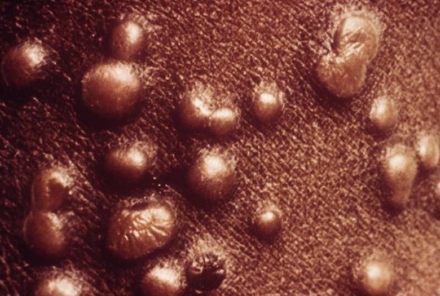 Global Smallpox Treatment Market Is Estimated To Witness High Growth Owing To Innovative Therapies
