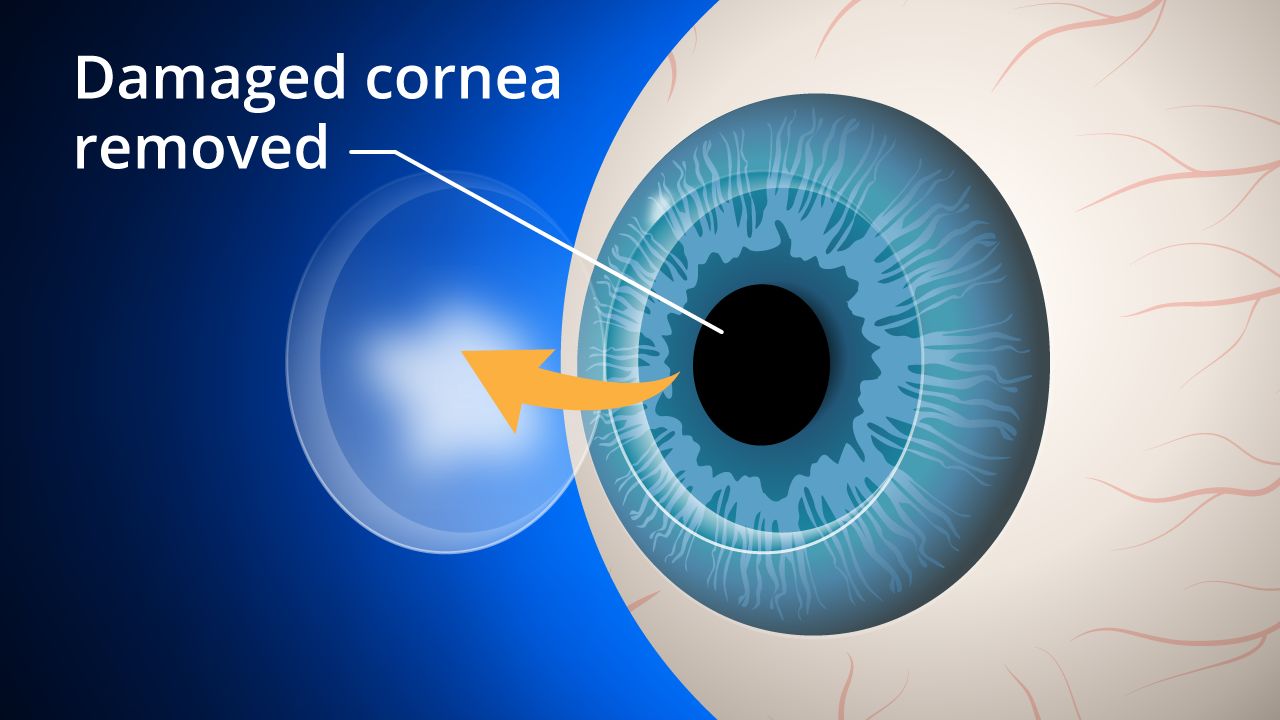 The Types of Corneal Transplant