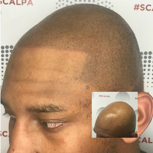 What are the signs of alopecia areata