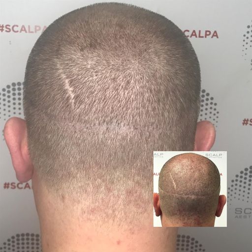 Micropigmentation Aftercare Tips