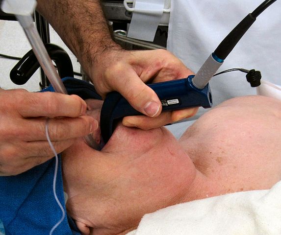 Intubation Cannulae Market Size, Share, Trends Analysis Report By Product, By Application, By Region And Global Forecast 2018-2023